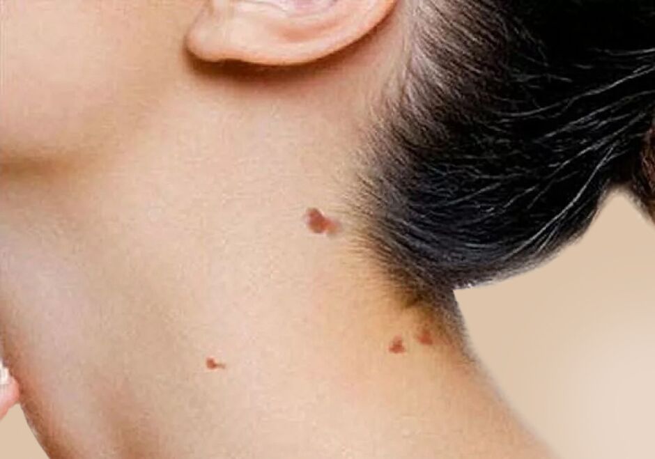 The appearance of papillomas on the neck after activation in the body of HPV. 