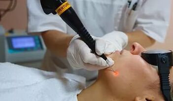 An effective procedure for removing papilloma on the face with a laser. 