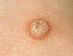 common wart on the skin