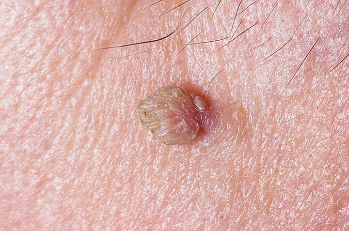 A wart on the skin that can be removed in many ways. 