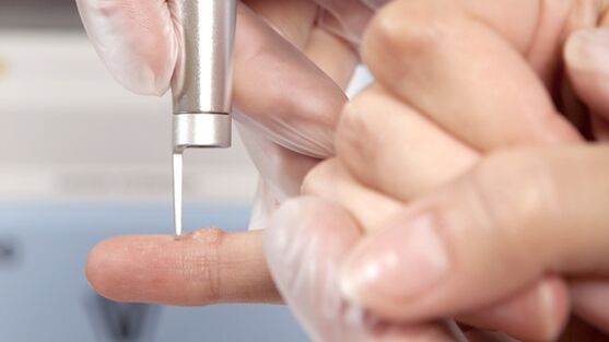 One of the methods to remove warts is the use of laser. 