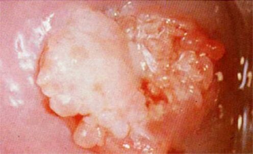 Cervical condoid