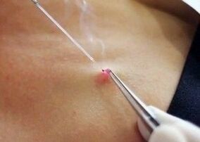 Laser elimination