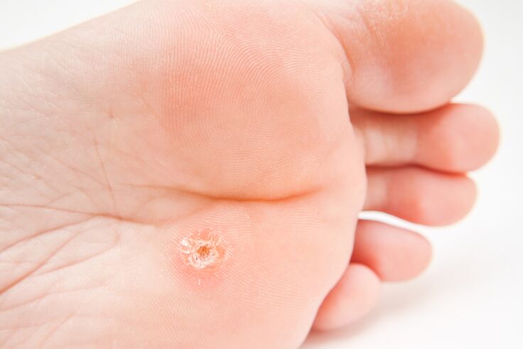 Warts Sole