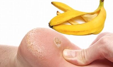 Banana peel for the treatment of a plantar wart