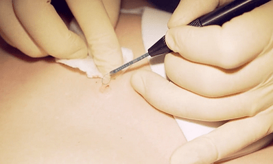 Surgical elimination of plantar wart
