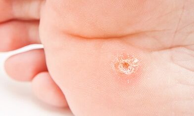 Why do plantar warts appear