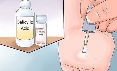 How to get rid of popular forms of papillomas