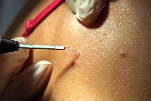 Removal of papillomas using the radio wave method.