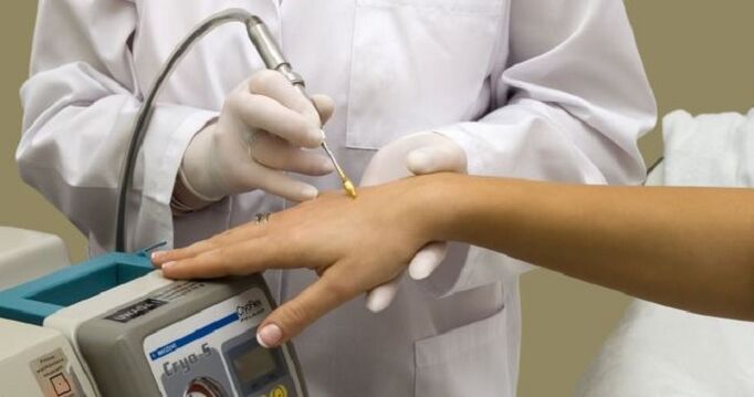 liquid nitrogen cautery