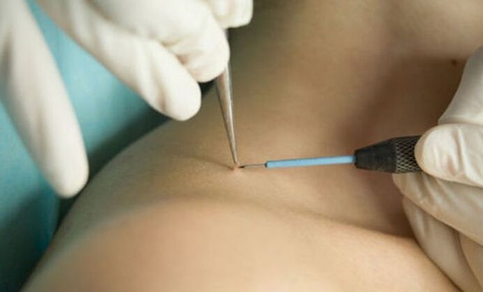 use of radio wave therapy