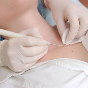 treatment of papillomas in men