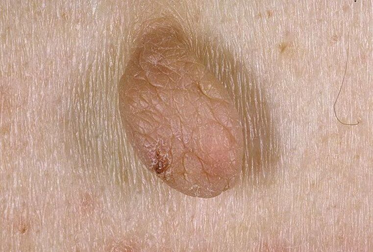 What are warts and papillomas like