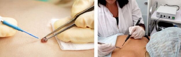 Electrocoagulation as a way to eliminate papillomas.