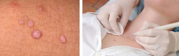 professional removal of papillomas on the body.