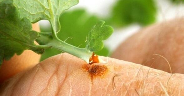 wart treatment with celandine