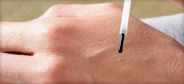 wart treatment with drugs