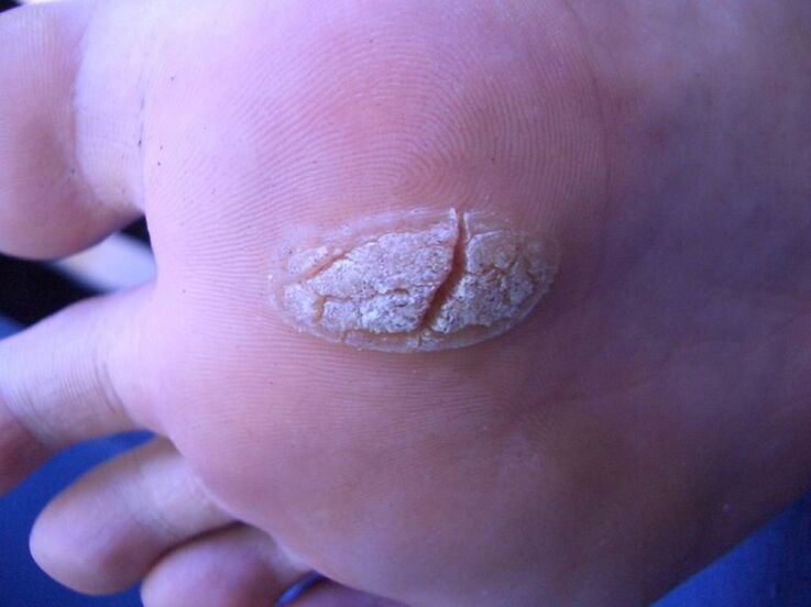 wart on the skin of the foot