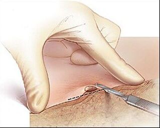 Surgical excision of the wart. 